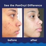 PanOxyl Acne Foaming Wash, For Face & Body, Maximum Strength, 5.5 oz (156 g) - Image 6